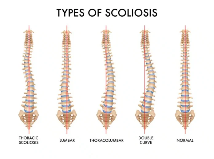 Comprehensive Scoliosis Treatment