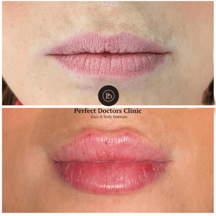 Juvederm Fillers in Dubai