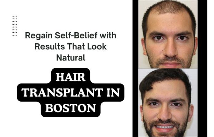 Regain-Self-Belief-with-Results-That-Look-Natural-Hair-Transplant-in-Boston