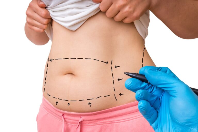 How to Prepare Mentally for Tummy Tuck Surgery with the Best Doctors in Dubai