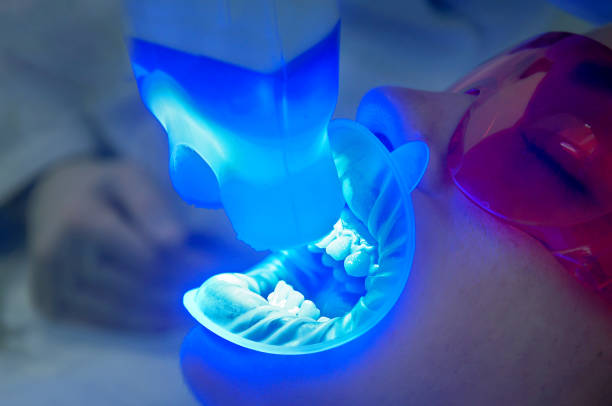 Teeth Whitening in Riyadh